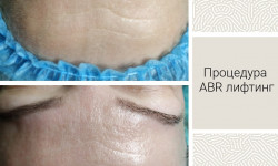 ABR ліфтинг Косметолог Елена Миколаїв