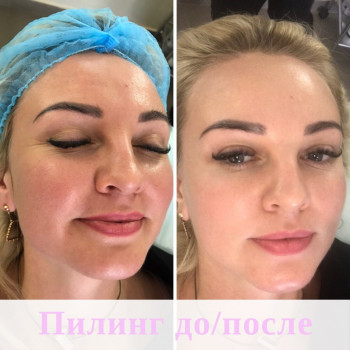 Поверхностный пилинг лица до и после процедуры