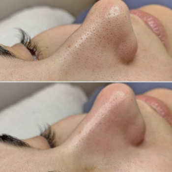 Чистка Hydra peel